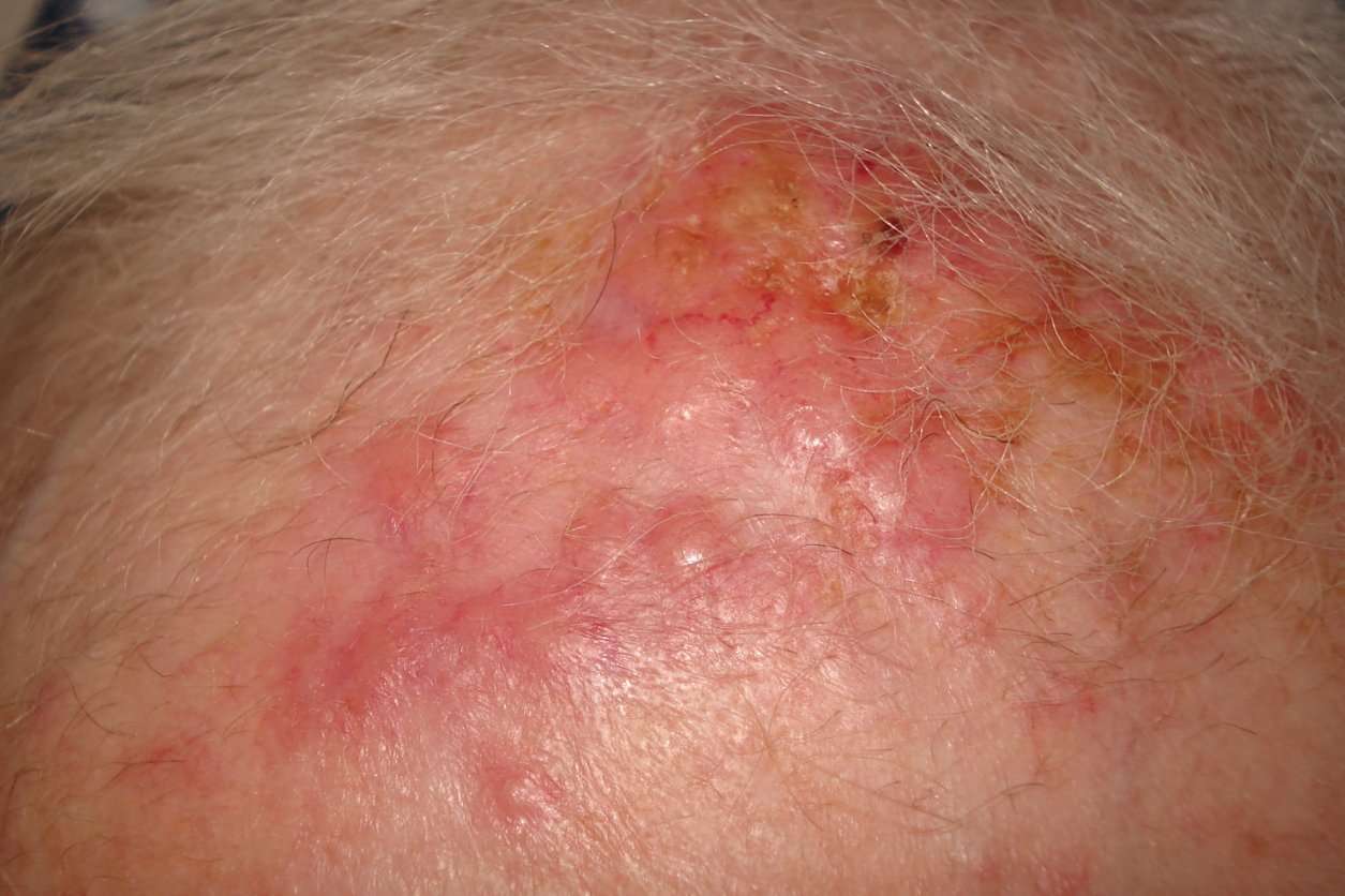 Skin metastases from lung cancer