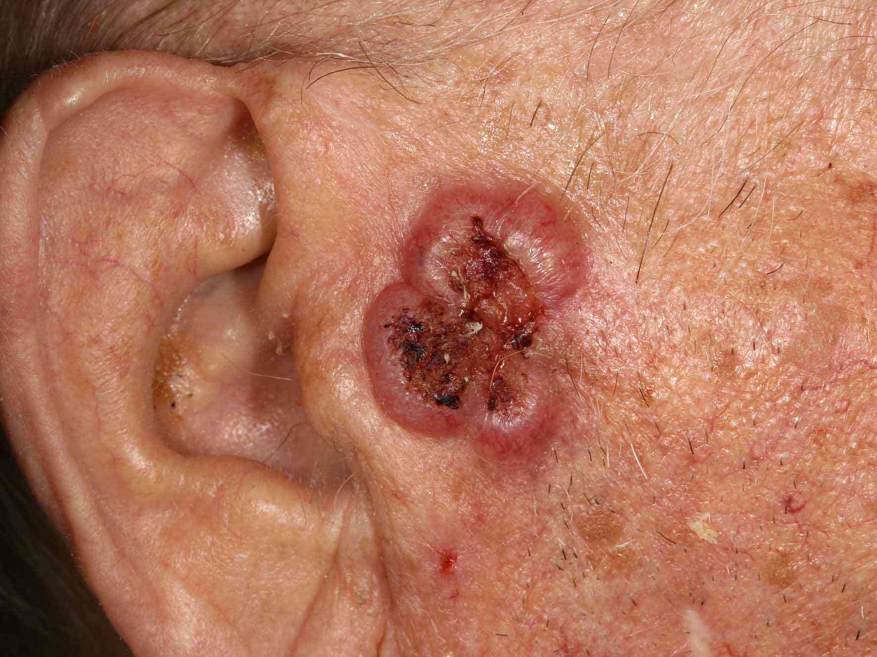 Squamous and Basal Cell Carcinoma Surgical Margins