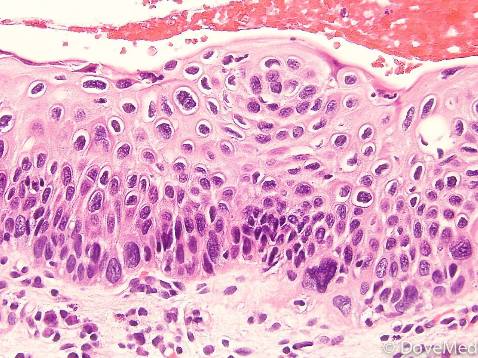 Squamous Cell Carcinoma In Situ of Anus