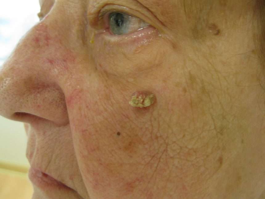 Squamous Cell Carcinoma of the Skin