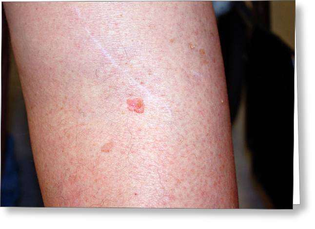 Squamous Cell Carcinoma On A Leg Photograph by National ...