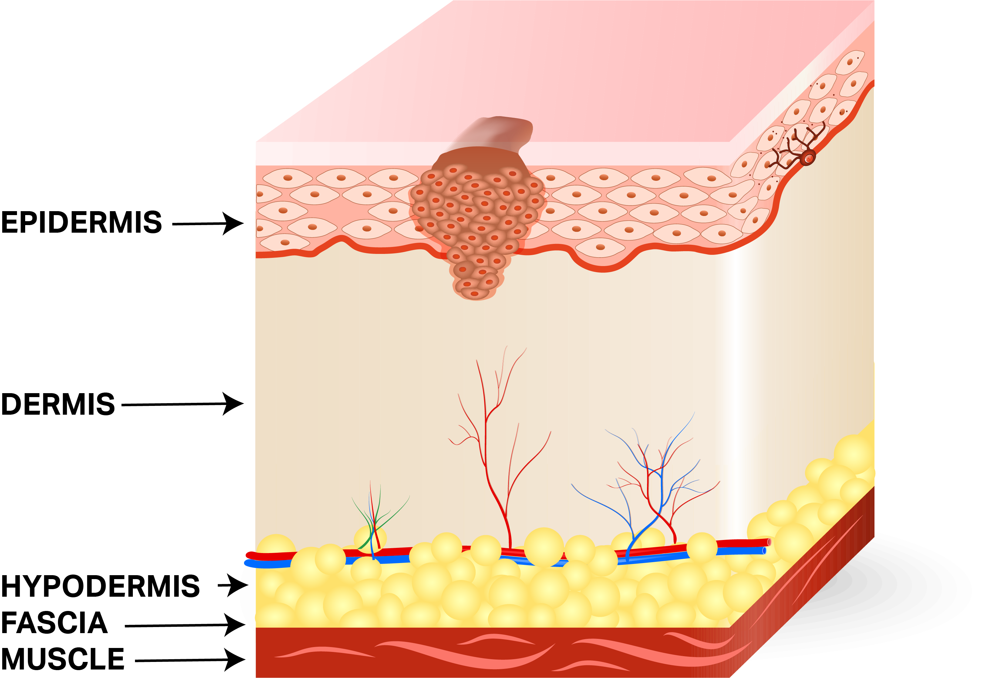 Staging Squamous Cell Skin Cancer: A Practical Description ...