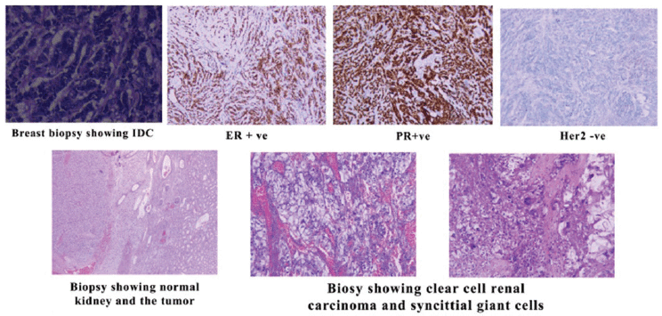 Synchronous invasive ductal carcinoma of the breast and ...