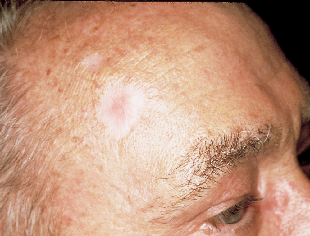 The Most Common Skin Cancer: Basal Cell Carcinoma  Skin ...