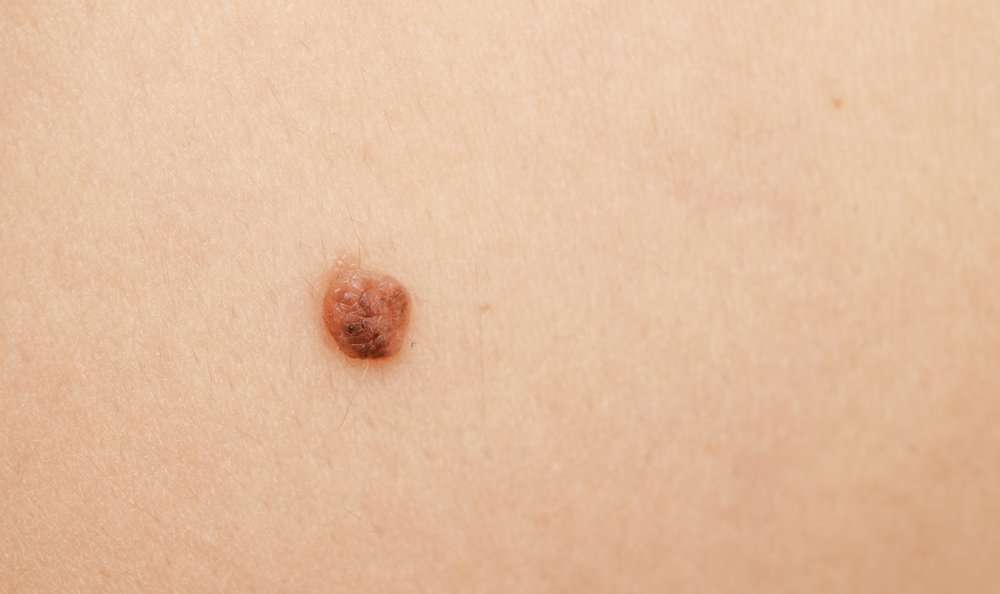 The Problem With âItâs ONLY Skin Cancer, Right?â?
