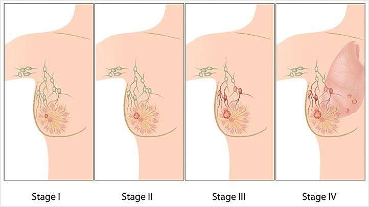 The Stages of Breast Cancer: What You Need to Know ...