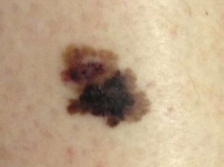 This Is What Melanoma Skin Cancer Looks Like