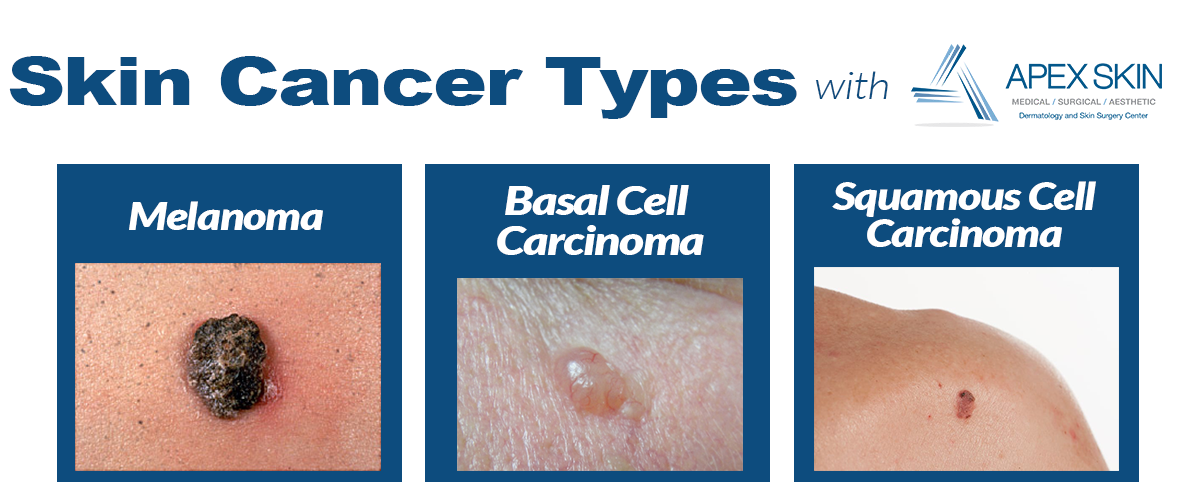 Top 10 Risk Factors for Skin Cancer â Apex Dermatology ...
