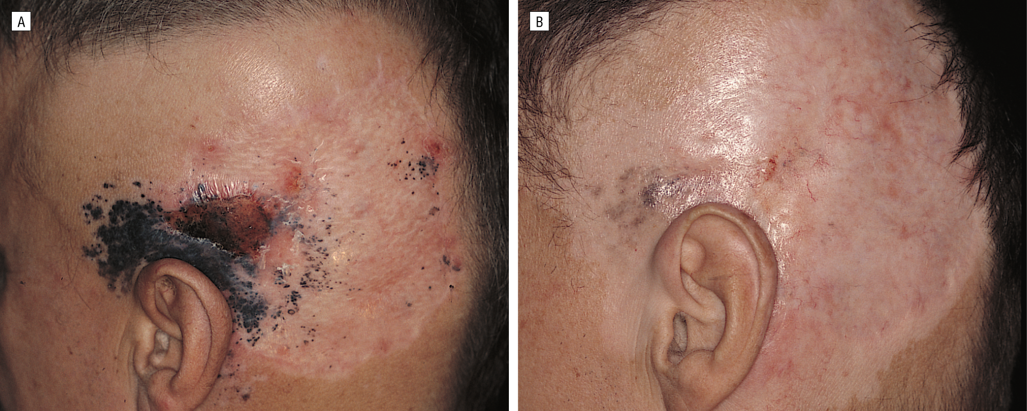 Topical Imiquimod in the Treatment of Metastatic Melanoma to Skin ...