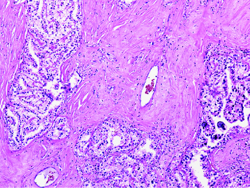 Translocation renal cell carcinoma composed of clear cells arranged in ...