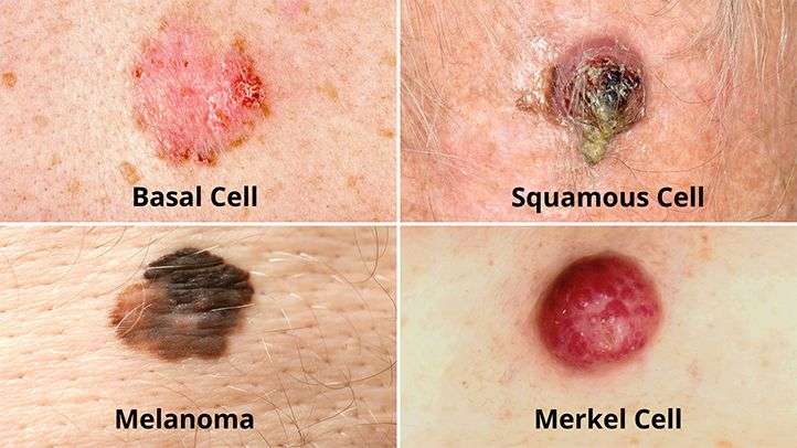 Types of Skin Cancer: Melanoma, Basal and Squamous Cell ...