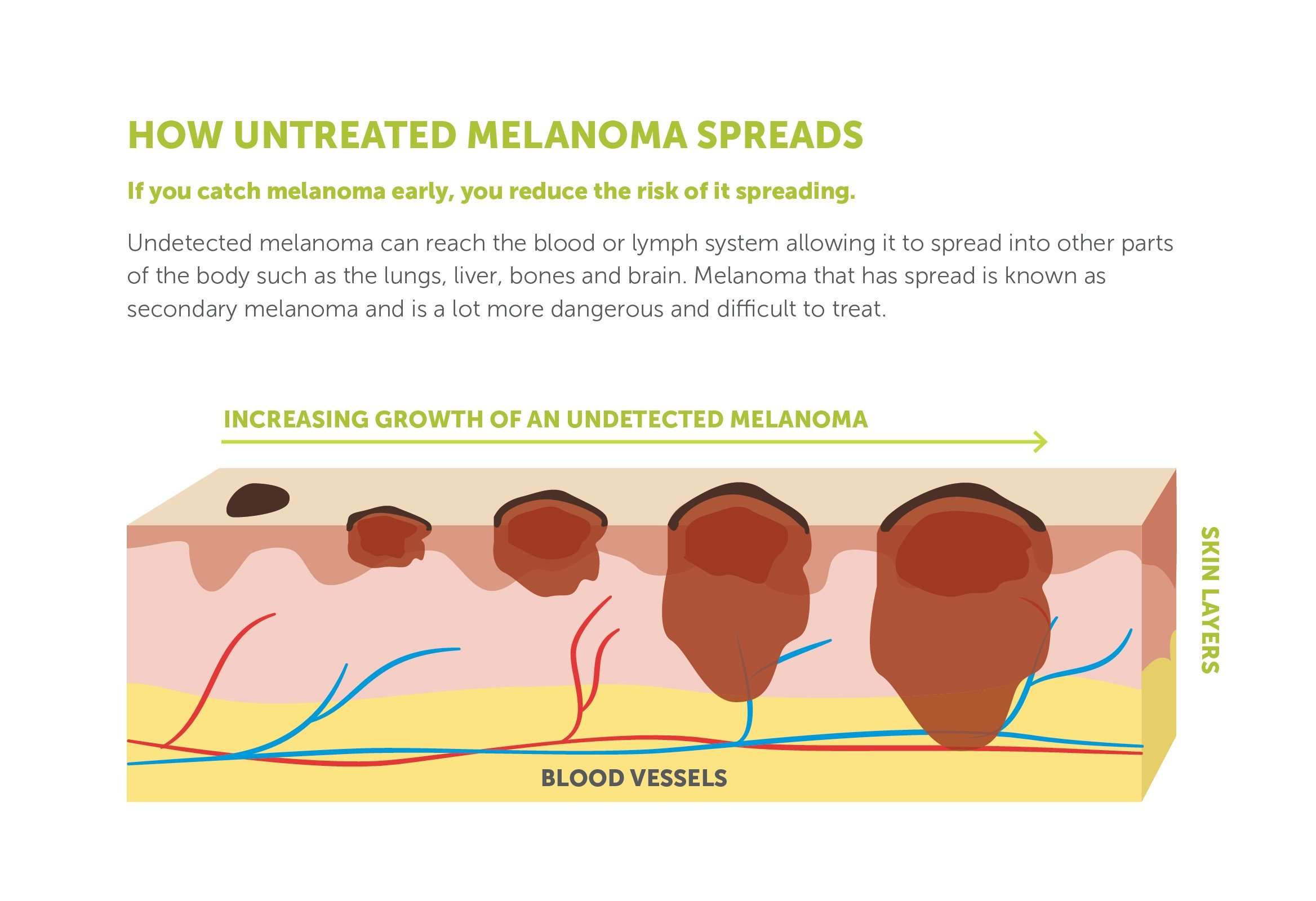 Understanding melanoma « melanomaWA