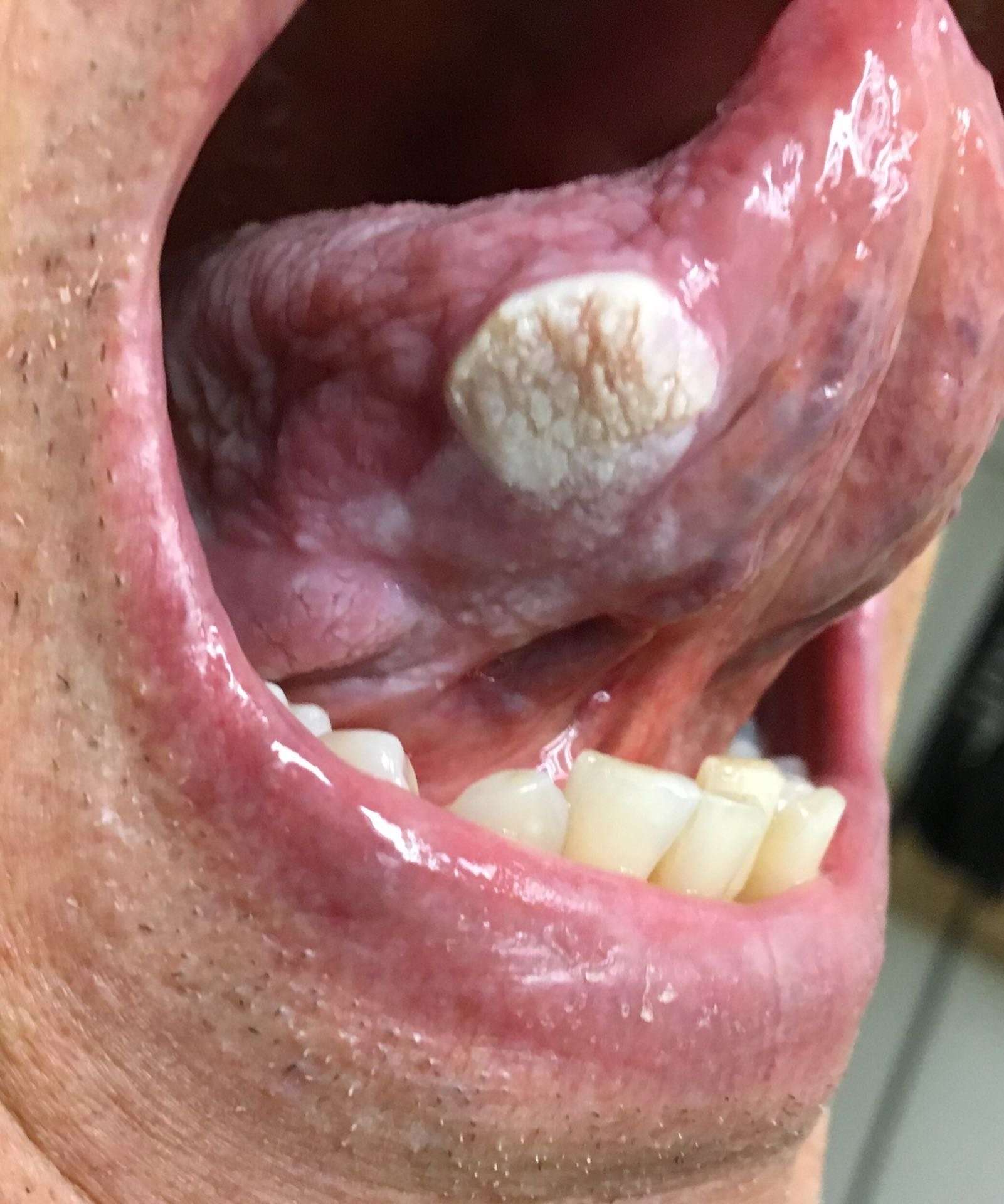 Verrucous squamous cell carcinoma of the tongue