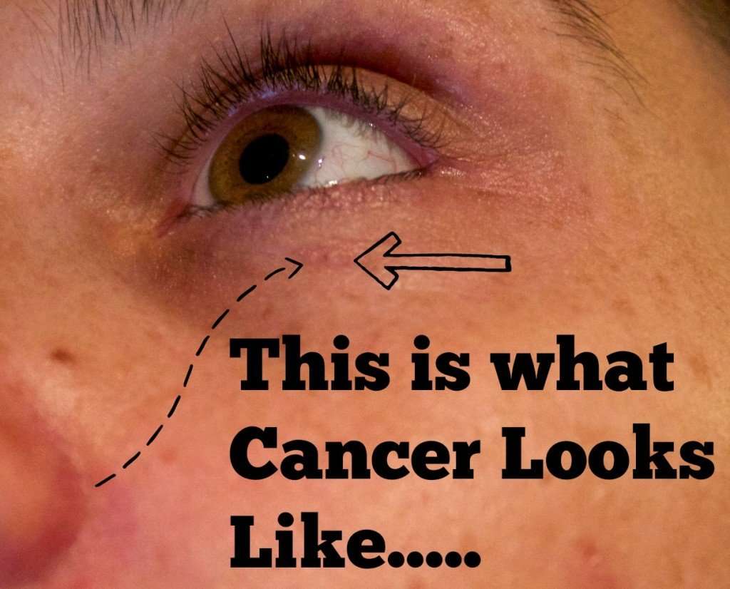 What Does Basal Cell Cancer Look Like On The Skin ...
