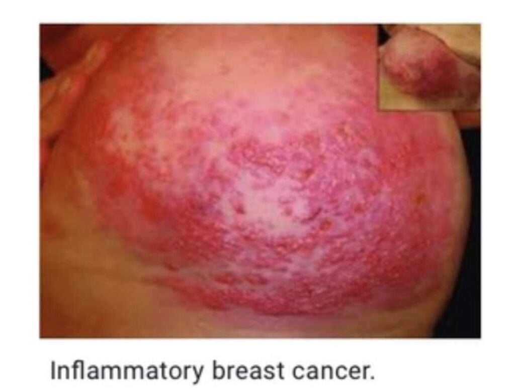 What Does Inflammatory Breast Cancer Rash Look Like ...