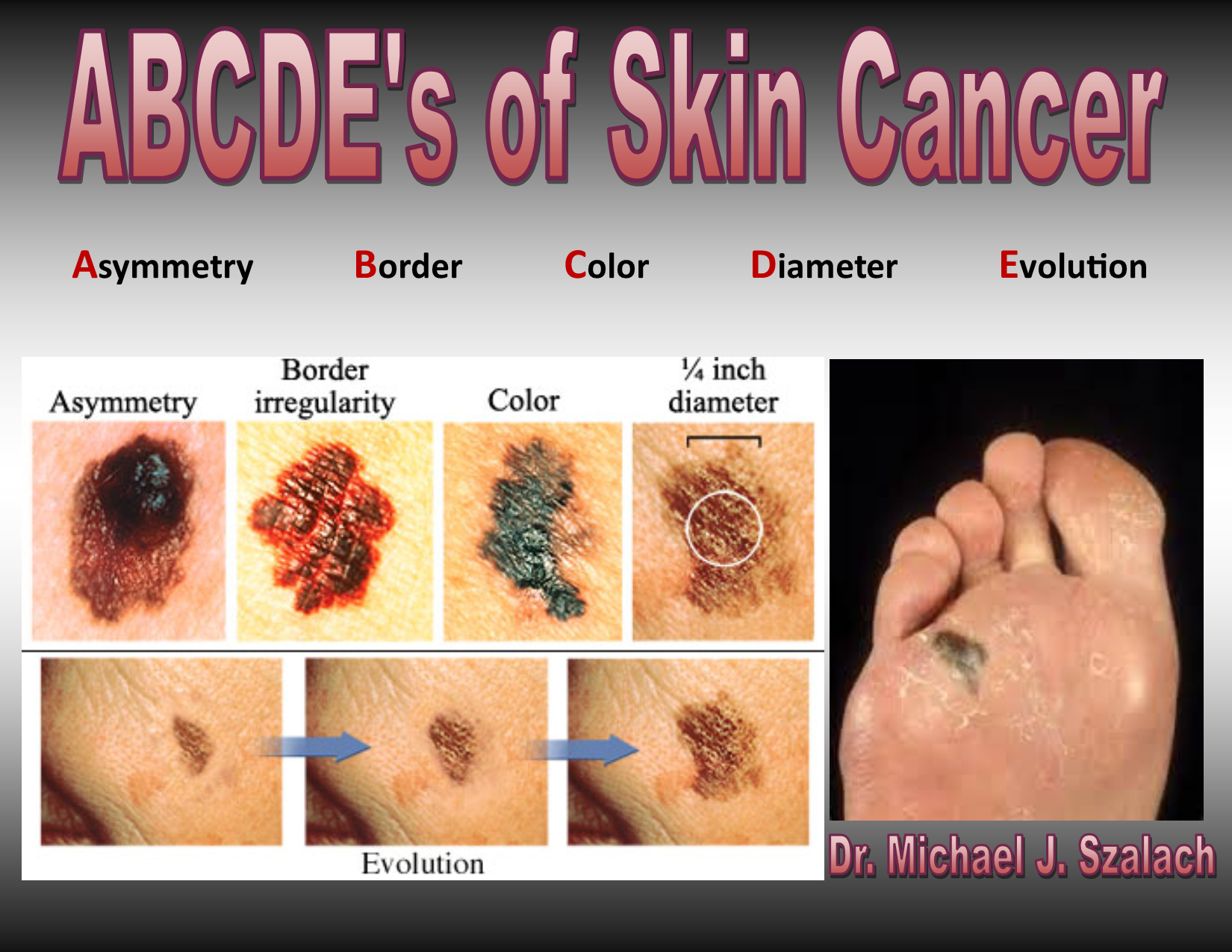 What Does Skin Cancer Between Toes Look Like