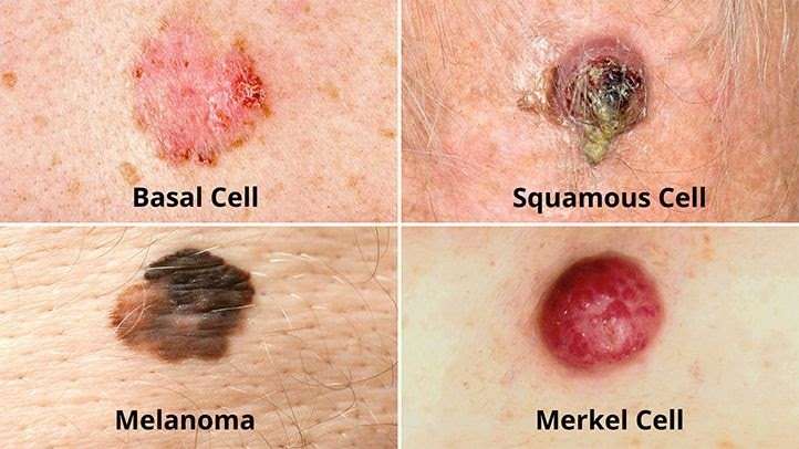 What Does Skin Cancer On The Nose Look Like Pictures ...