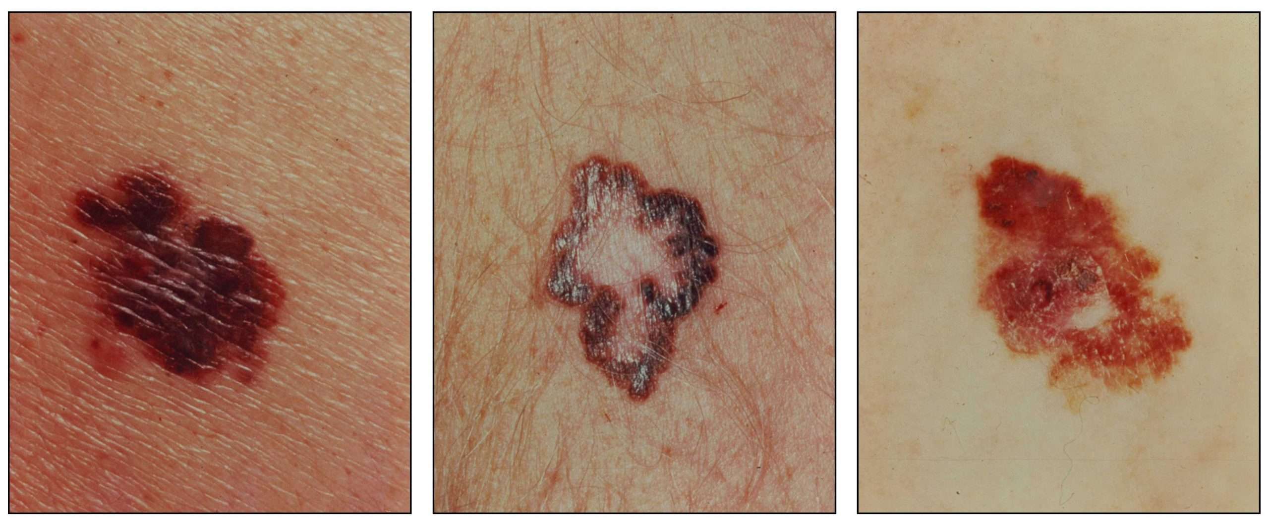 What Does Stage 1 Skin Cancer Look Like
