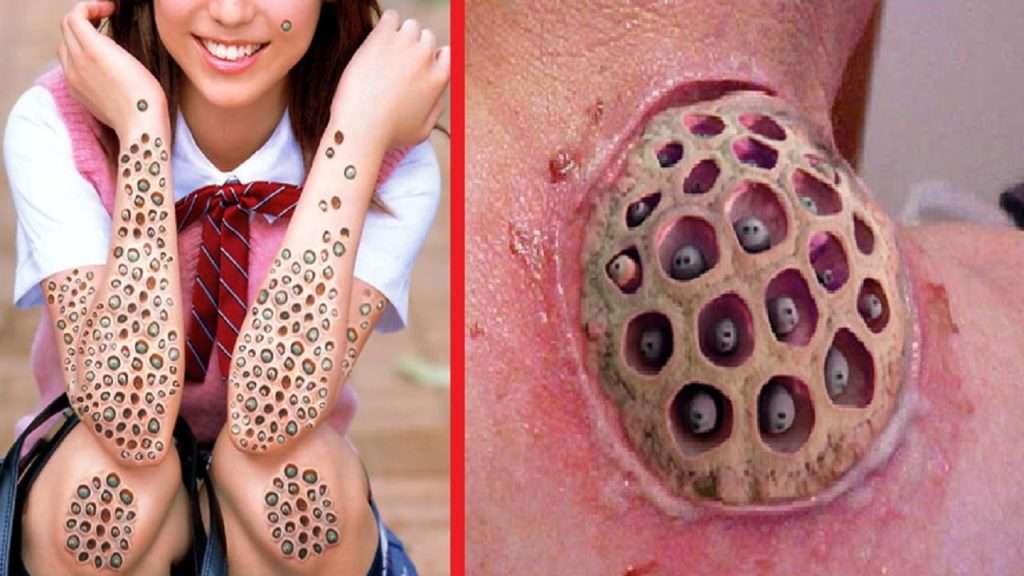 What Is Trypophobia? (fear of holes), Causes, Symptoms, and Treatment ...