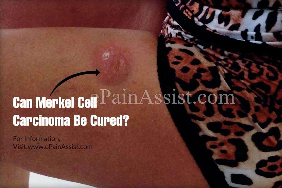 What Leads To Merkel Cell Carcinoma & Can It Be Cured?