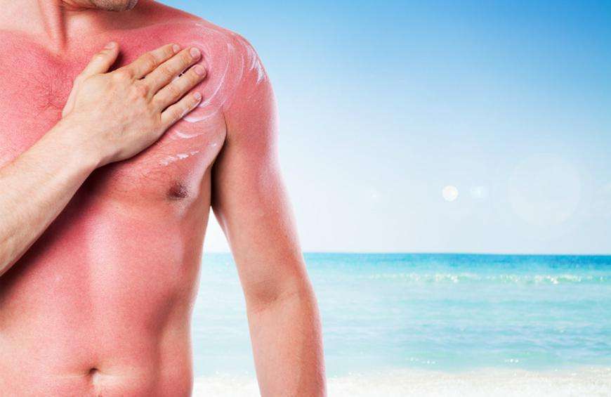 What You Should Do After a Sunburn