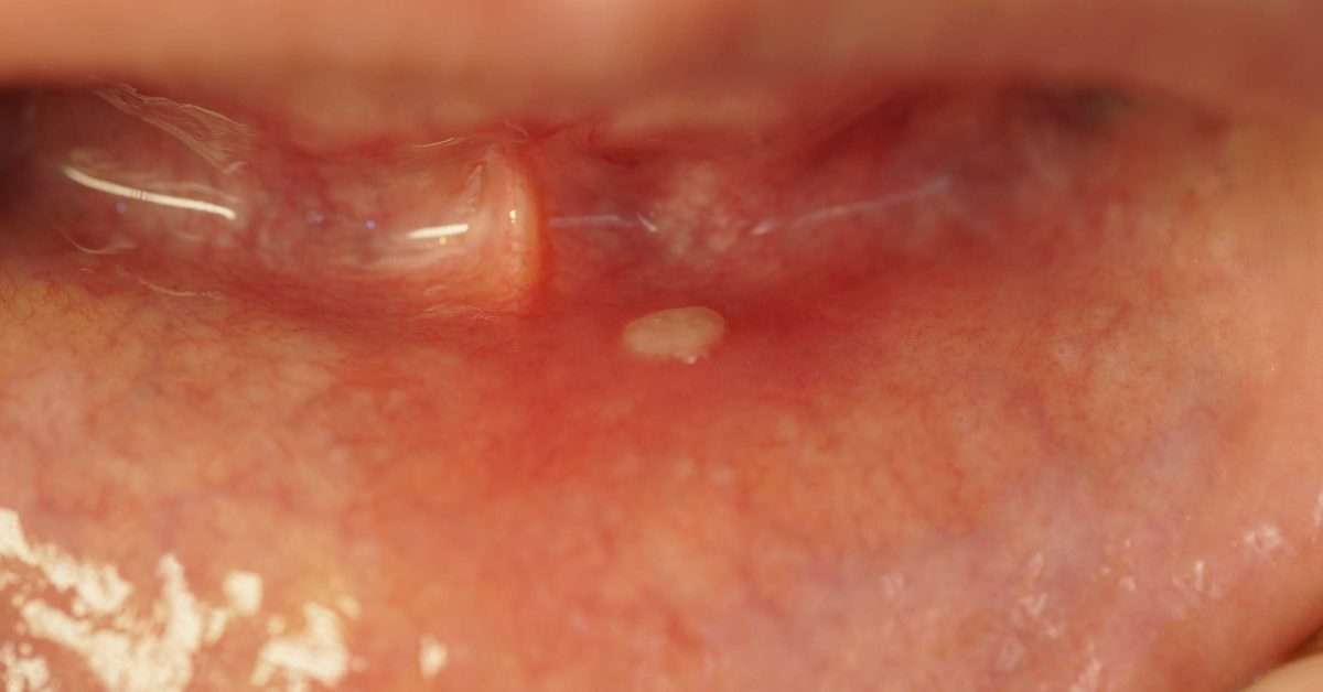 White spots and sores on gums: Causes, treatment, and symptoms