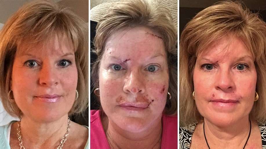 Woman shares skin cancer photos to show effects of tanning ...