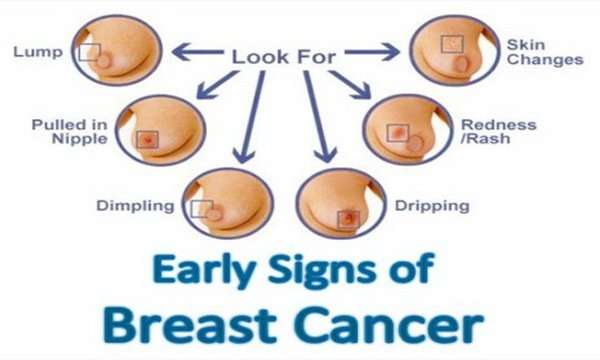 Women Must Stop Ignoring These 5 Signs Of Breast Cancer ...