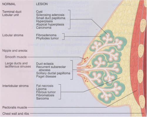 ð Invasive ductal carcinoma pathophysiology. What Is ...